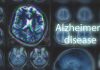 Brain scans labeled Alzheimers disease background