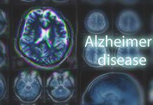 Brain scans labeled Alzheimers disease background